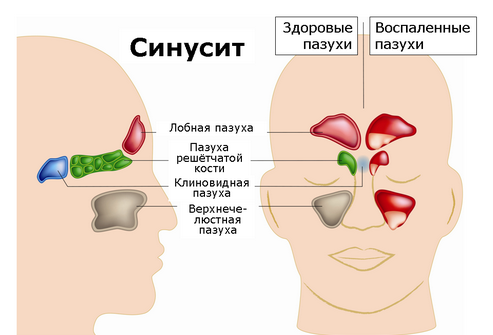 Синусит носовой пазухи 1