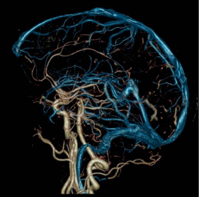 Angiografiya-sosudov-golovnogo-mozga