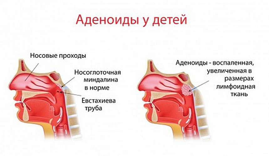 Схемы лечения аденоидов у детей без операции